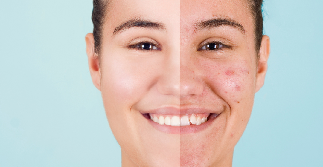 Acne: How Your Skin Care May Help